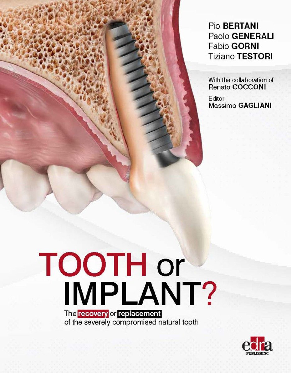 Libro Tooth or Implant? The recovery or replacement of the severely compormised natural tooth di Pio Bertani; Paolo Generali; Fabio Gorni; Tiziano Testori - ean 9781957260525 - Edra