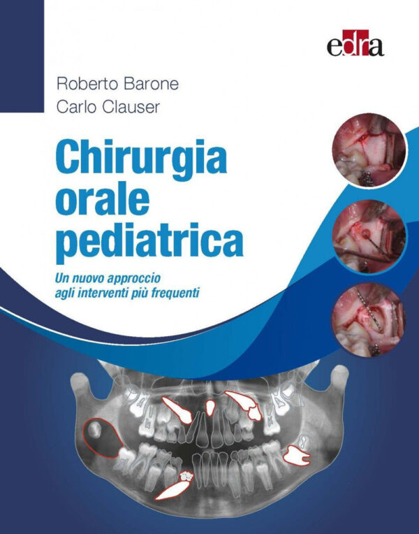 Libro Chirurgia orale pediatrica. Un nuovo approccio agli interventi più frequenti di Roberto Barone; Carlo Clauser - ean 9788821451829 - Edra