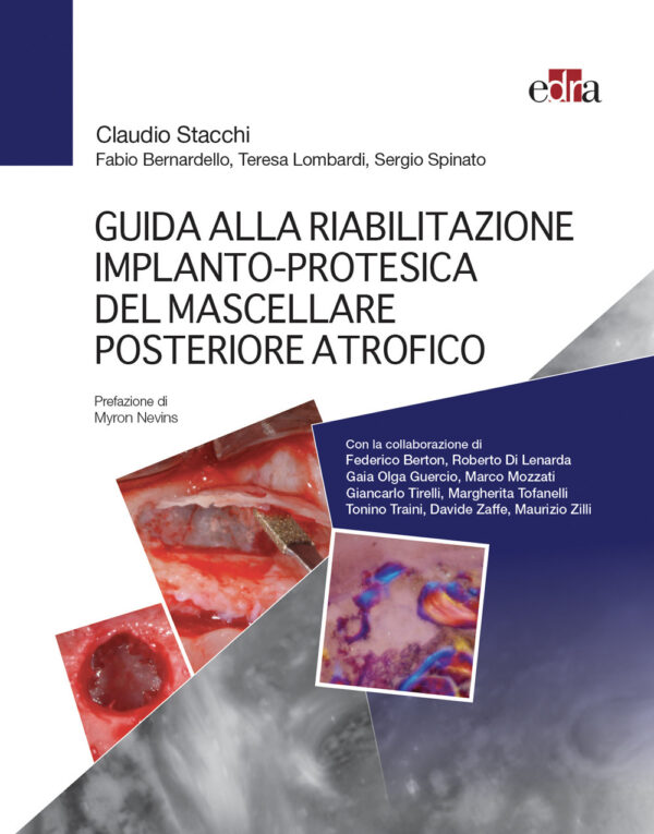 Libro Guida alla riabilitazione implantoprotesica del mascellare posteriore atrofico di Claudio Stacchi; Fabio Bernardello; Teresa Lombardi; Sergio Spinato - ean 9788821453557 - Edra