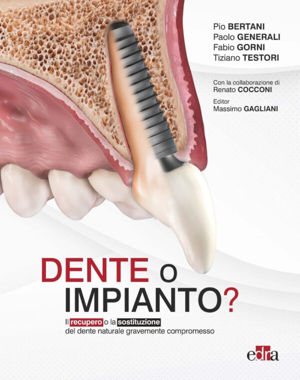Libro Dente o impianto? Il recupero o la sostituzione del dente naturale gravemente compromesso di Pio Bertani; Paolo Generali; Fabio Gorni; Tiziano Testori - ean 9788821454325 - Edra