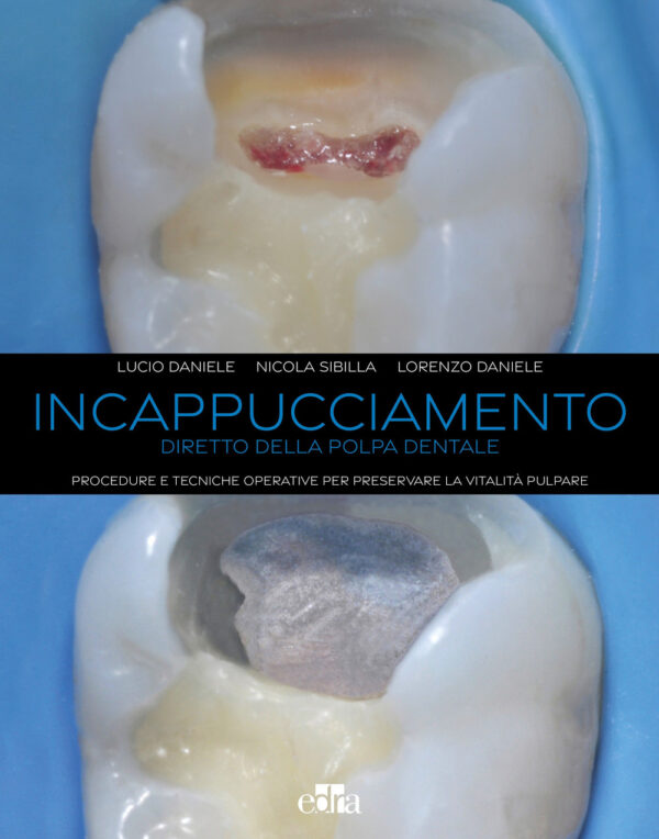 Libro Incappucciamento diretto della polpa dentale. Procedure e tecniche operative per preservare la vitalità pulpare di Lucio Daniele; Nicola Sibilla; Lorenzo Daniele - ean 9788821456800 - Edra