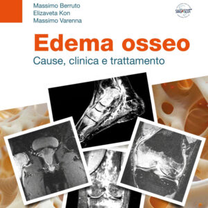 Libro Edema osseo. Cause