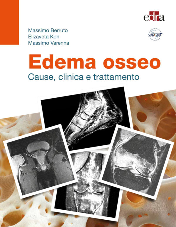 Libro Edema osseo. Cause