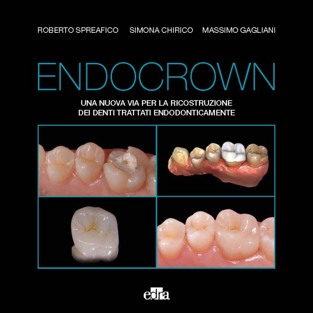 Libro Endocrown. Una nuova via per la ricostruzione dei denti trattati endodonticamente di Roberto Spreafico; Simona Chirico; Massimo Gagliani - ean 9788821457944 - Edra