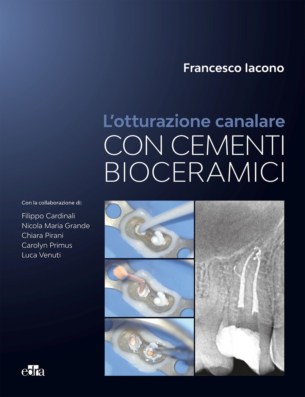 Libro otturazione canalare con cementi bioceramici di Francesco Iacono - ean 9788821459115 - Edra